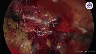 MANAGEMENT OF ECTOPIC PREGNANCY BY LAPAROSCOPY LAPAROSCOPIC SALPINGECTOMY [upl. by Vannie]