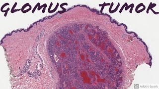 Glomus Tumor 5Minute Pathology Pearls [upl. by Adan]