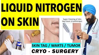 Cryotherapy  Super Freezing Skin tags Warts or Tumor with Liquid Nitrogen  Cryosurgery [upl. by Ramona]