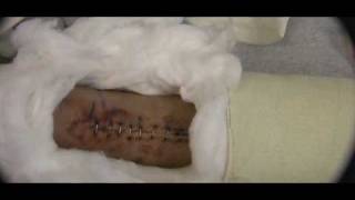 10 Days After Ruptured Achilles Tendon Surgery  Wound Video [upl. by Dallas]