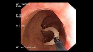 Ascaridosis on colonoscopy Аскариды при колоноскопии [upl. by Innavoj]