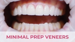 Minimal Preparation Porcelain Veneers Smile Transformation [upl. by Glovsky]