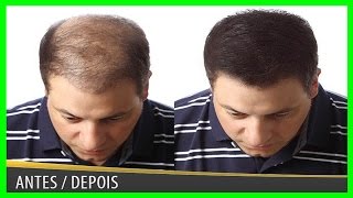 Como Fazer Nascer Cabelo e Deixar de Ser Careca em 30 Dias ➜ CURA DA CALVICE 😍 [upl. by Scheer]