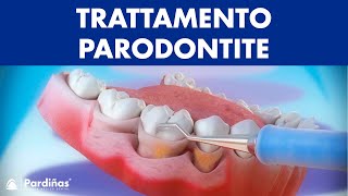 Trattamento parodontite – Curettage e sondaggio parodontale © [upl. by Ellednahc421]