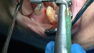 Implantes endodoncia coronas  Odontologia Multidisciplinar Dentistry Multidisciplinary [upl. by Wobniar]