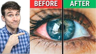 The 1 Best Natural Dry Eyes Treatment [upl. by Eicyaj]