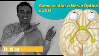 Como avaliar o nervo óptico na RM [upl. by Tyrrell]