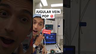 Jugular vein under valsalva [upl. by Kcuhc]