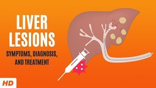 Liver Lesions Symptoms Diagnosis and Treatment [upl. by Yboc166]