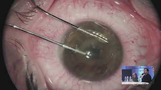 Intrastromal Pockets with FEMTO LDV Z6 in lenticule transplantation in keratoconus by Dr Stodulka [upl. by Airlia]