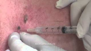 Removal of seborrheic keratoses with scissor excision For medical education NSFE [upl. by Brunk289]