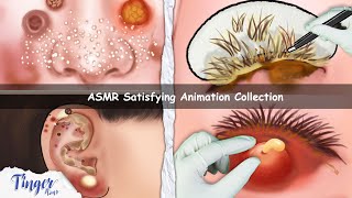 ASMR CARE ANIMATION COLLECTION  Cleaning Big Hole Swollen Ear Dry Eyelid Sebum Extrusion [upl. by Sheeree409]