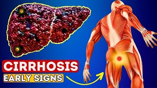 12 Early Signs of Liver CIRRHOSIS  LIVER is DYING [upl. by Nadia]