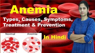 Anemia  Types of Anemia  Causes Symptoms Treatment Prevention Risk Factors  In Hindi [upl. by Thgirw]