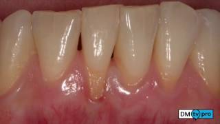 Abundo  Root coverage on a lower incisor 2stage treatment Preview [upl. by Akselav]