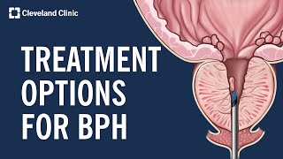 Treating Benign Prostatic Hyperplasia BPH [upl. by Saitam346]