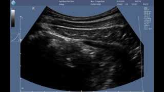 Abdominal RUSI ultrasound  correct contraction of the transversus abdominis [upl. by Josephine]