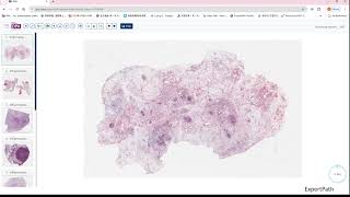 inflammatory myofibroblastic tumorIMT desmoid fibromatosis GIPATH [upl. by Issor10]