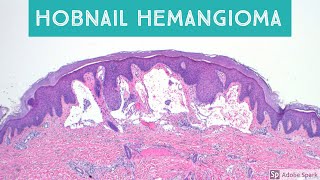 Hobnail Hemangioma Targetoid Hemosiderotic Hemangioma Retiform Hemangioendothelioma and Mimics [upl. by Rubbico]