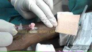 Dorsalis pedis artery cannulation [upl. by Arukas6]