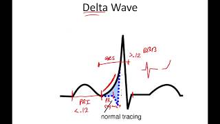 12Lead EKG Part 4 Preexcitation [upl. by Wenona]