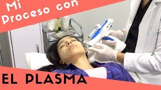 ME HICE EL PLASMA EN MI ROSTRO  Paso a paso  Plasma rico en plaquetas [upl. by Uwton]