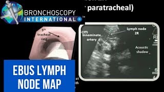 EBUS Lymph Node Map  Nodal Anatomy [upl. by Darooge]