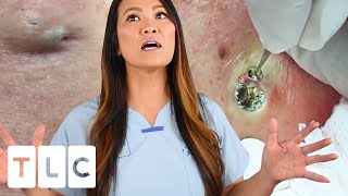 quotThe Award For The Biggest Blackheadquot amp A Juicy Cyst  Dr Pimple Popper This is Zit [upl. by Nivloc]