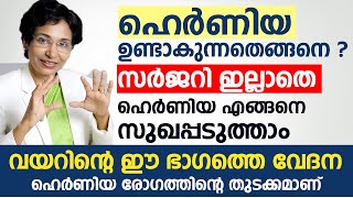 ഹെർണിയ രോഗം ഉണ്ടാകുന്നതെങ്ങനെ  സർജറി ഇല്ലാതെ Hernia എങ്ങനെ സുഖപ്പടുത്താം  Hernia Malayalam [upl. by Theodor899]