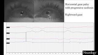 Teaching Video NeuroImages Horizontal gaze palsy with progressive scoliosis [upl. by Gnouh]