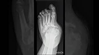 Identify the arthropathy diabetes radiology [upl. by Ozneral]