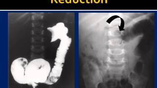 Intussusception Reduction HowTo [upl. by Montgomery]