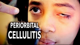 PERIORBITAL CELLULITIS Painful  Dr Paul [upl. by Flavius218]