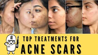 HOW TO TREAT ACNE SCARS  DOCTORLY [upl. by Rufus155]