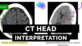 CT Head Interpretation for Beginners  OSCE Guide  UKMLA  CPSA [upl. by Roosnam]