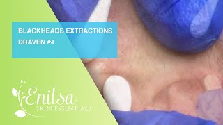 Blackheads Extractions Draven 4th Treatment [upl. by Llyrpa]