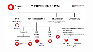 Microcytic anemia  anemia of chronic diseases  sideroblastic anemia Lead poisoning [upl. by Aihsein]