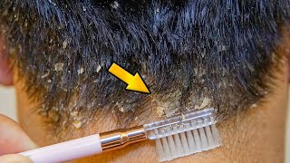 Dandruff Treatment At Home Big Flakes Dandruff Removal [upl. by Nellak]