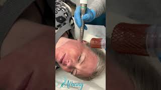 Fotona Fractional ablative laser and Fotona smooth [upl. by Melc231]