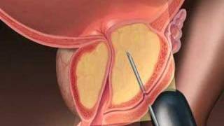 Botox for Enlarged ProstateMayo Clinic [upl. by Dickson]