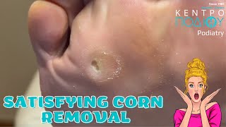 Corn Removal podiatrycare Podiatrist podologos κεντροποδιου KentroPodiou KentroPodioucalluses [upl. by Susy633]