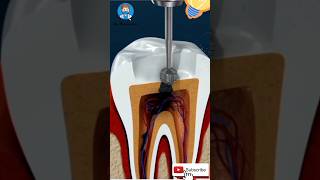 Root canal treatment🥺 Endodontic treatmentRootCanalTreatment EndodonticTreatment ToothDecay [upl. by Brower409]