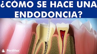 ¿Qué es una Endodoncia  Tratamiento de conductos o desvitalización del diente paso a paso © [upl. by Fromma]