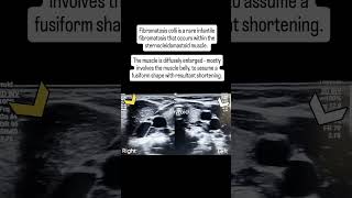 Fibromatosis colli radiology [upl. by Repooc]