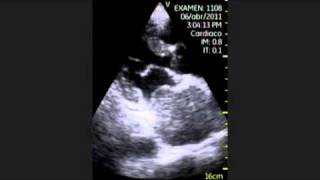 VSCAN Extrinsic compression of the left atrium [upl. by Myrwyn]