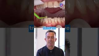 Orthodontie lingual et vestibulaire  collage en technique mixte 🦷 [upl. by Ainslie429]