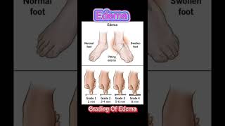 Edema  Pitting Edema  Swelling on legs  What is pitting Edema  Dr Irfan Mughal [upl. by Attirb]