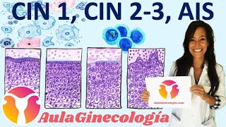 ALTERACIONES HISTOLÓGICAS EN EL CÉRVIX CIN 1 CIN 23 AIS  Ginecología y Obstetricia [upl. by Caldeira]