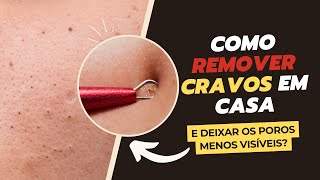 Como Remover CRAVOS em Casa com Extrator [upl. by Rahsab428]