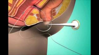 Fistula Treatment in Pune  Fistula Hospital in Pune  Dr Ashwin Porwal  Fistula Surgeon Pune [upl. by Mazurek]